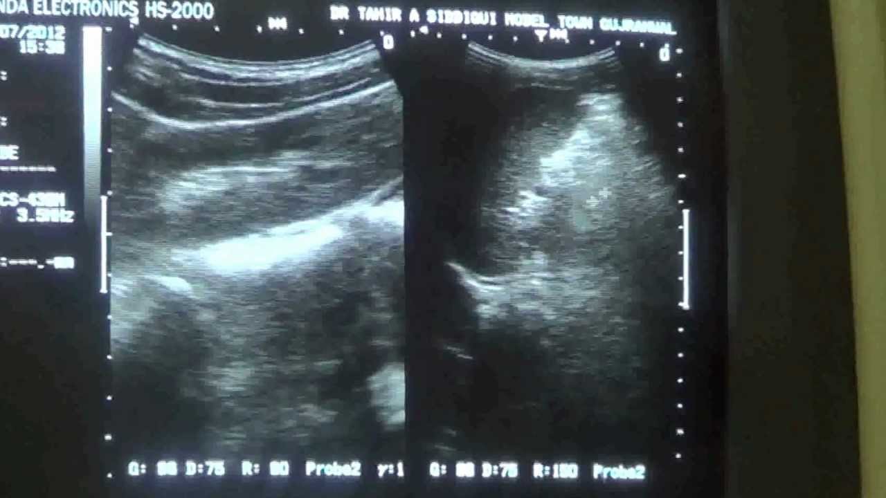 ultrasound HORSE SHOE SHAPED KIDNEYS YouTube