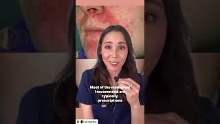 How to treat Perioral Dermatitis | Dr. Mamina, Board-Certified Dermatologist
