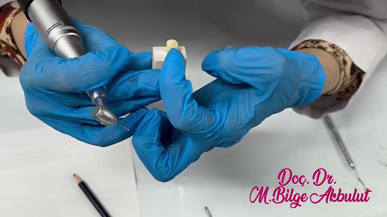 Endodontic access cavity on an upper canine / Üst kanin endodontik giriş kavitesi