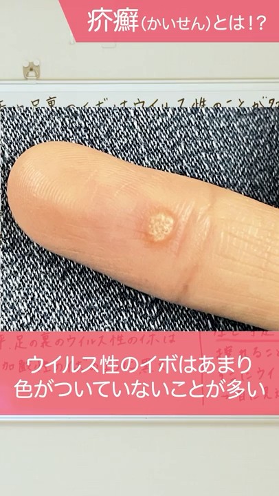 手や足のイボはウイルス性のことが多い #千里中央花ふさ皮ふ科