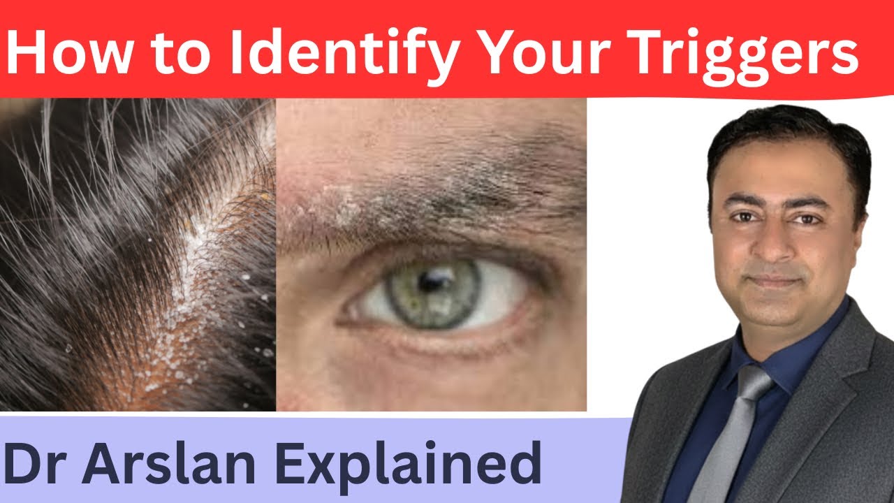 How to Identify Your Triggers in Seborrheic Dermatitis & Flakes | Dr Arslan Skin Care (Homeopathy)