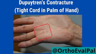 Dupuytren's Contracture (Tight Cord in Palm of Hand) screenshot 3