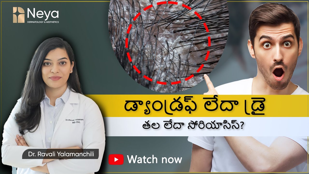 Scalp psoriasis vs Dandruff vs Dry scalp | Dandruff Treatment in Telugu | Dr. Ravali Yalamanchili