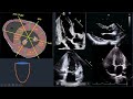 Wall Motion Abnormality in Echo