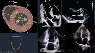 Wall Motion Abnormality in Echo