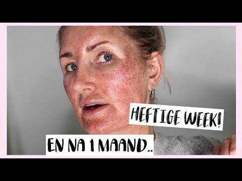 Video: Back Acne-littekens: Behandelingen En Chemische Peelings