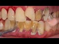 Teeth Tartar Scaling