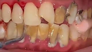Teeth Tartar Scaling