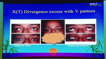 AIOC2020 GP016 T4 Dr Pradeep Sharma  Managing Intermittent Divergent Squint