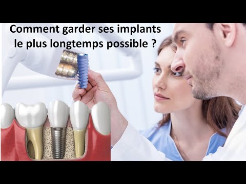 Vidéo: Problèmes D'implants Dentaires Précoces Et Tardifs