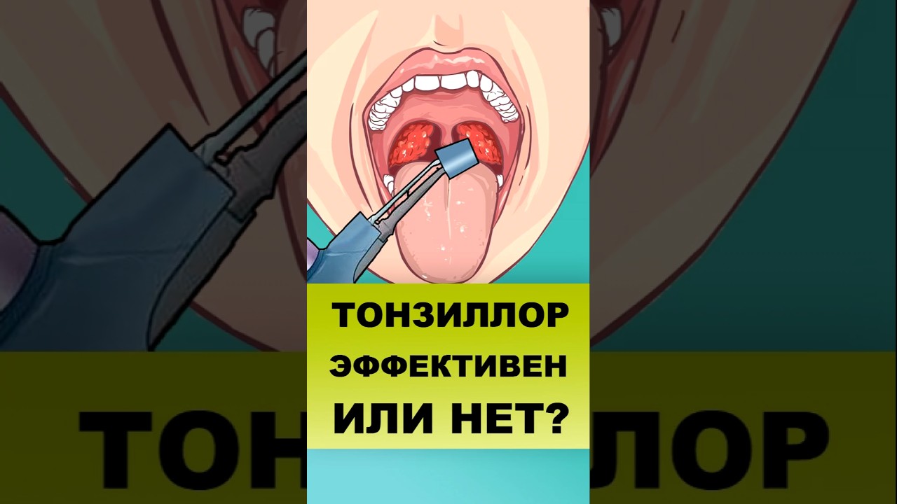 ПОМОЖЕТ ЛИ МНЕ ТОНЗИЛЛОР? #тонзиллор #промываниеминдалин #пробкивгорле