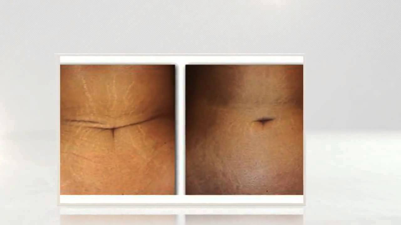 Dermelastic Serum Get Rid Of C Section Scars and Stretch Marks YouTube