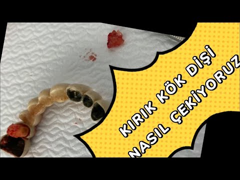 Diş çekimi,kırık diş kökünün çıkarılması//tooth extraction, broken tooth root extraction,asmr