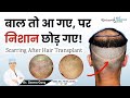 Hair Transplant Scars | Scarring After Hair Transplant | बाल तो आ गए, पर निशान छोड़ गए!