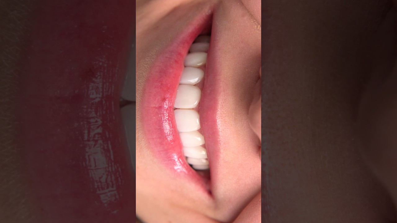 This Smile Makeover Left Us Speechless #smilemakeover #smiletransformation #veneers #austindentist