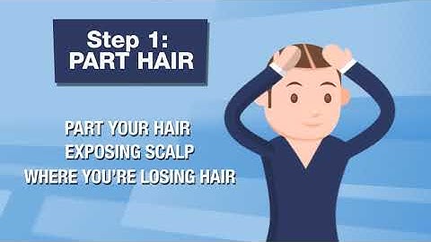 Minoxidil 5 hướng dẫn sử dụng