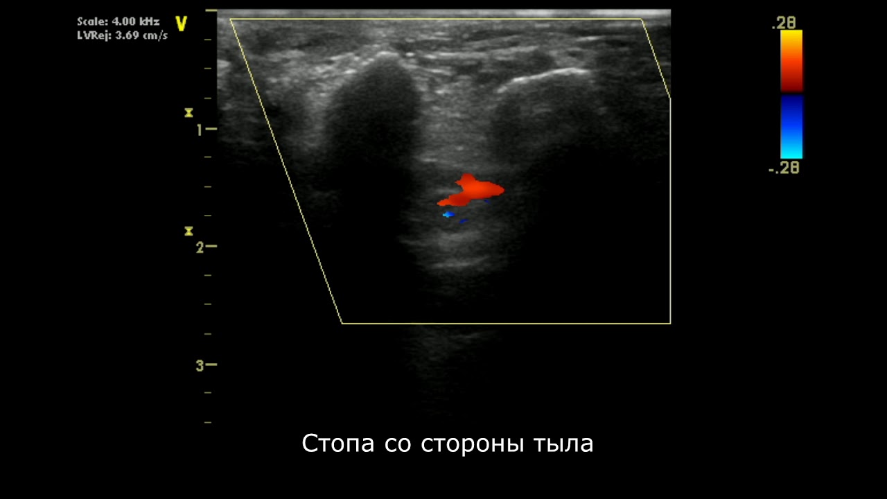 УЗИ подошвы стопы - YouTube