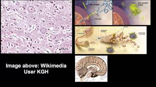 Biological basis of alzheimer's disease