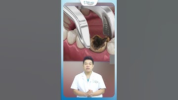 Nhổ Răng Số 6 Hàm Dưới Bị Sâu Hỏng | Nha Khoa Minh Châu