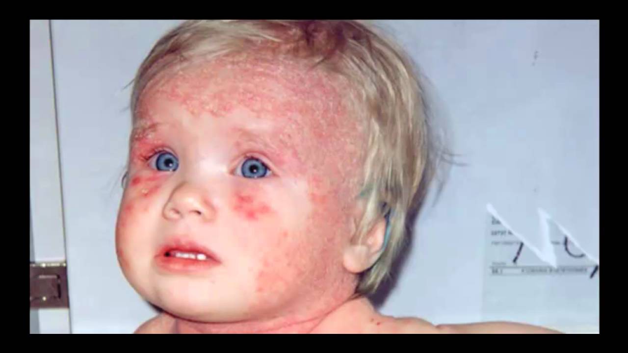 Аллергия на мыло у ребенка и у взрослых