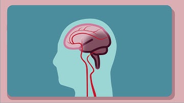Basilar Artery Stroke - English