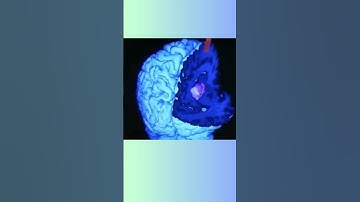 Slivit AI Model: The Future of Instant and Accurate MRI Scans