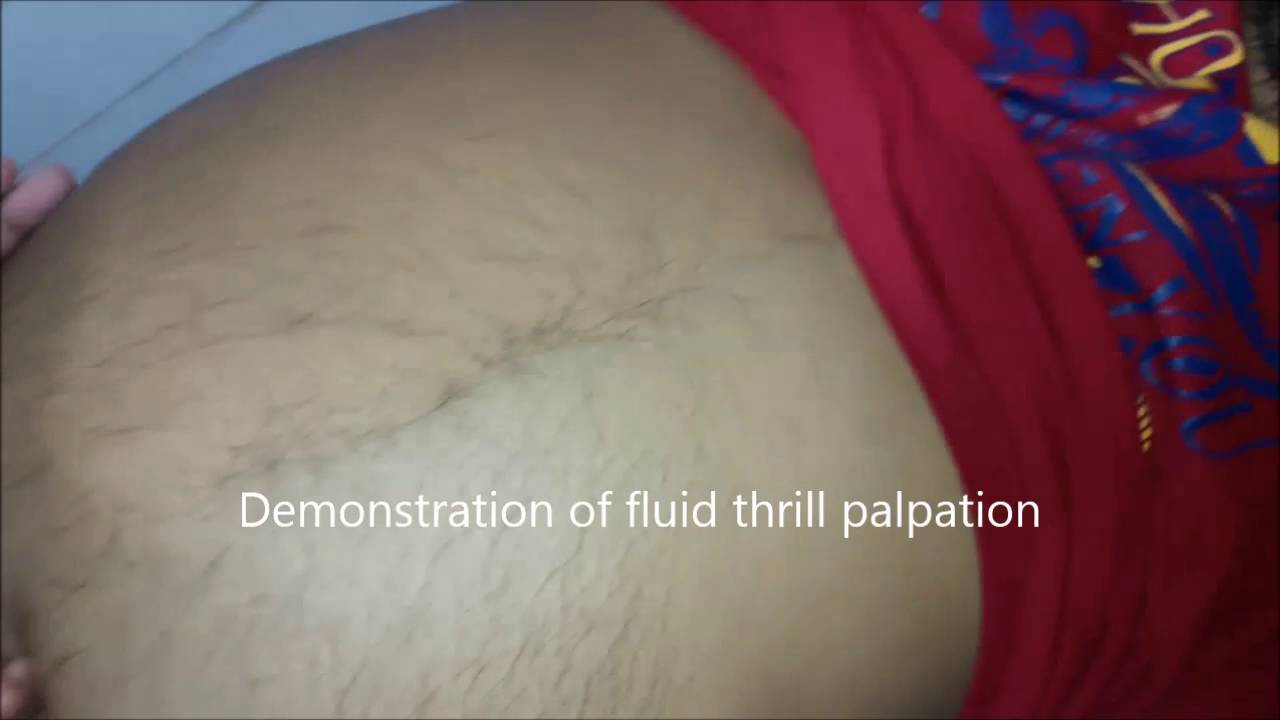 Ascites in chronic liver disease with severe anaemia - YouTube