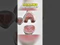 Total Knee Replacement|3D ANIMATIONS| #TotalKneeReplacement#TKR#KneeReplacementSurgery#fyp
