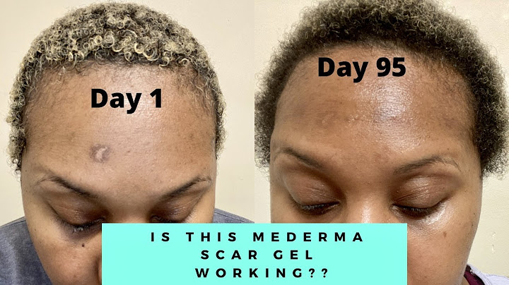 Mederma advanced plus scar gel review năm 2024