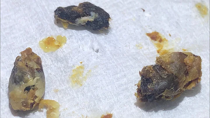 860 - Impossible Ear Wax Removal