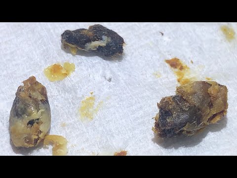 860 - Impossible Ear Wax Removal