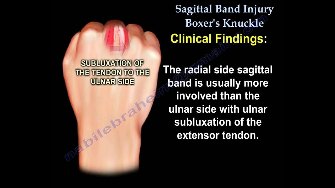 Sagittal Band Injury Boxer's Knuckle - Everything You Need To Know - Dr