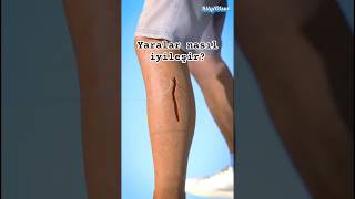 Yaralar Nasıl Iyileşir?