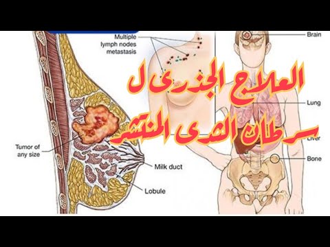 العلاج الجذرى لسرطان الثدى المنتشر وهل حقا يمكن الشفاء التام