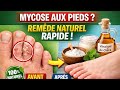 soigner les mycoses aux pieds naturellement à la maison #mycoses #soinnaturel #mycoseauxpieds #remed