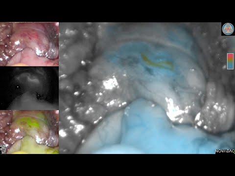 Low Anterior Resection And Near Infrared Technology