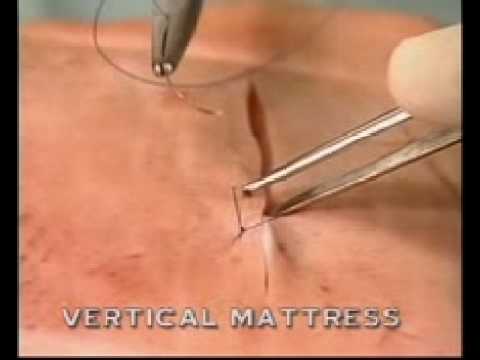 vertical mattress suture #10