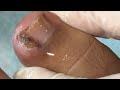 Ep_6553 Ingrown toenail removal 👣 นั่งรถตู้มาจากอ่างทองค่ะ 😄 (clip from Thailand)