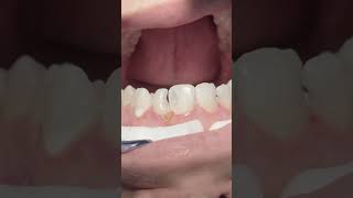 Anterior Teeth Composite Restoration After Root C Treatment