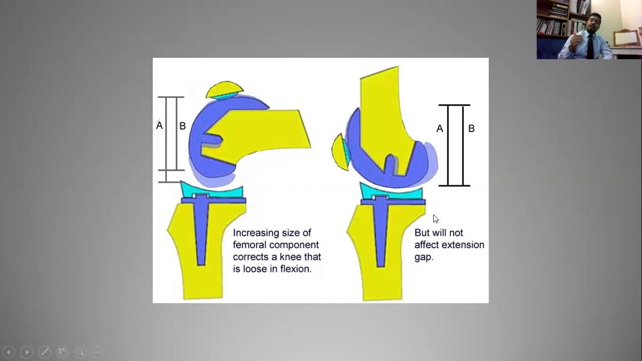 Arthroplasty KNEE, SHOULDER Orthopedic FCPS/DNB/ MS MCQs Test 5