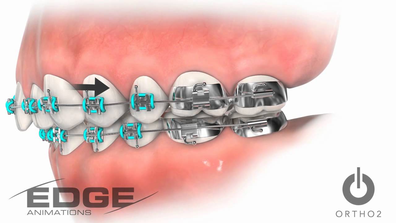 Crawford Orthodontics Pokey Wire YouTube