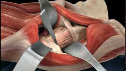 Retractor Placement Exposure | Hip Replacement Surgery | Anterior Approach | Animation Demo