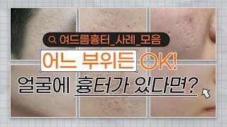 여드름 흉터, 나도 치료했어요! 실제 사례 모음 공개! #새살침 #여드름흉터치료 #로담한의원