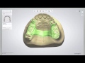 Removable partial denture  how its designed  digital dentistry