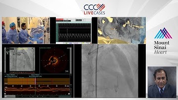 FFR & OCT Guided Staged PCI of LAD Diagonal Bifurcation - Aug 2019
