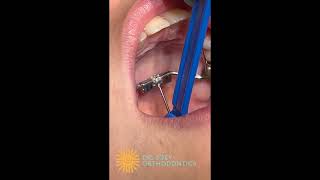 Orthodontic Expander Tutorial