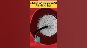 How heart bypass surgery is done ? हार्ट बायपास सर्जरी कैसे की जाती है? #shorts #short #trending