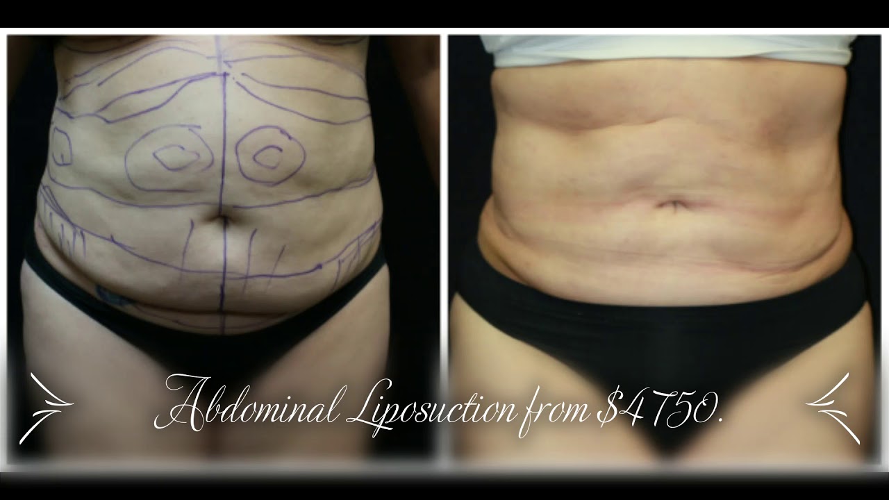 Liposuction Special