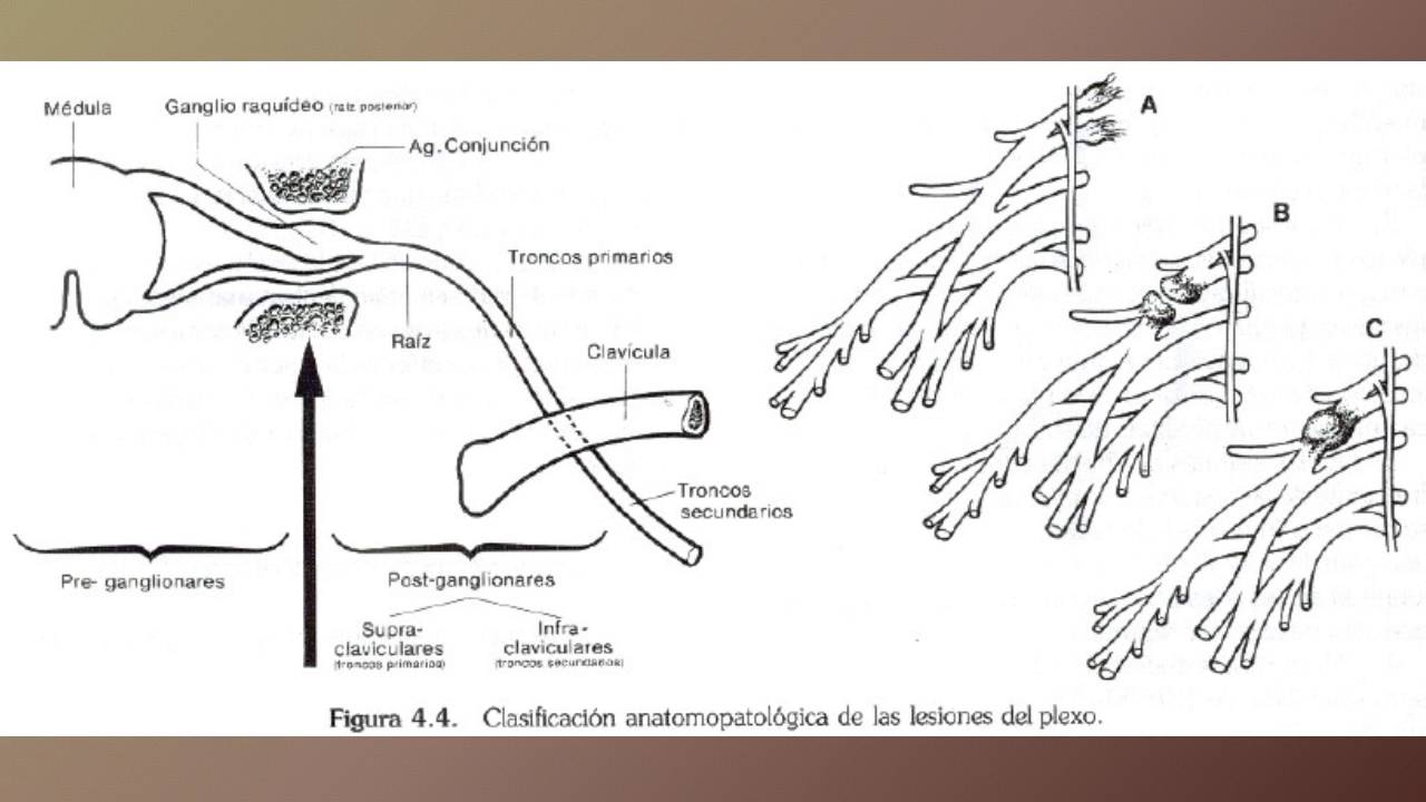 usa map LESIONES DEL PLEXO BRAQUIAL