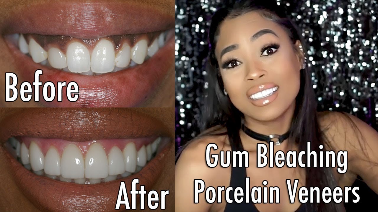 Stunning Porcelain Veneers and Gum Bleaching at Los Angeles’ Best Dentist Southland Dental